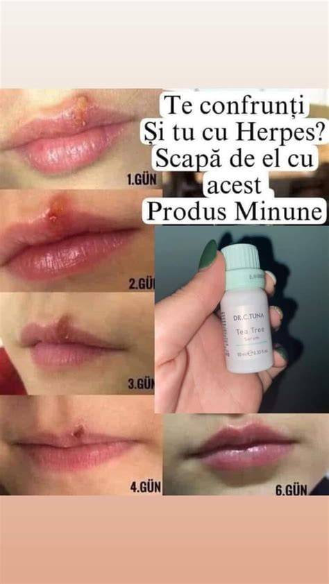 Infografic: Recomandări pentru herpes în sarcină