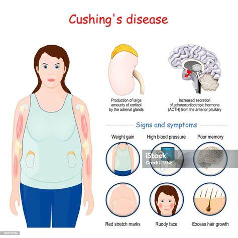semnele sindromului Cushing la copii (ilustrativ)