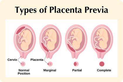 Diagnoza placenta previa prin ecografie