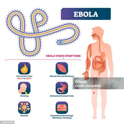 Schema simptomelor gastroenteritei și a diferențierii de gripă