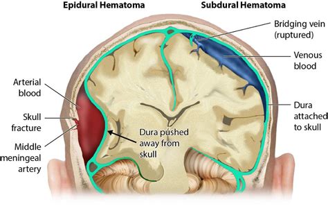 diagrama hematom subcorionic