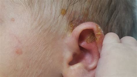 copil cu stafilococ auriu