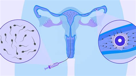 Infografic: Procesul inseminării intrauterine