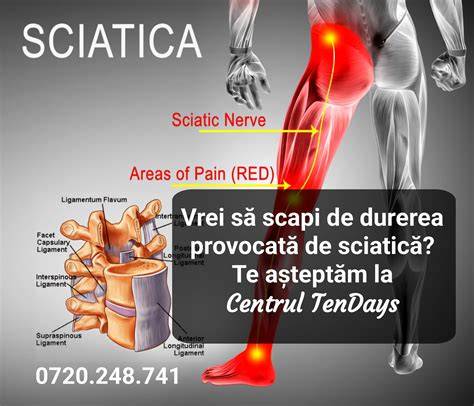 Infografic: Anatomia nervului sciatic si traseul lui in raport cu sarcina