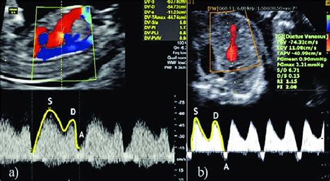 Ecografie Doppler a ductus venosus fetal