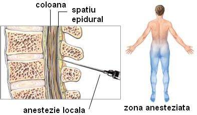 Infografie: Cum arata o cezariana (anestezie locala vs. generala, incizii)