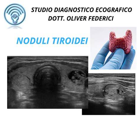 Diagrame si imagini ale structurii tiroidei, noduli si caracteristici Doppler