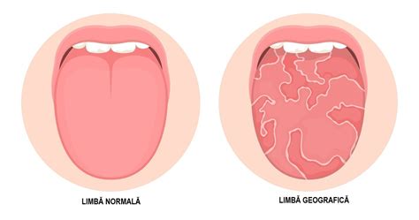 Infografic: Cauze comune ale petelor pe limba la copii