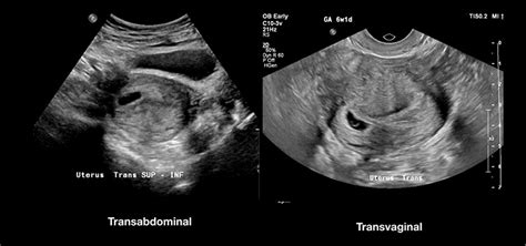 Imagine de descriere: reprezentare a diferitelor tipuri de ecografii obstetrice (transabdominal, transvaginal), plus utilizarea Dopplerului