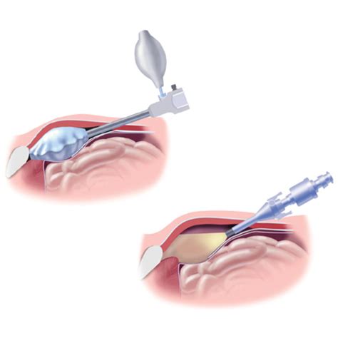 Chirurgie laparoscopică pentru hernie ombilicală