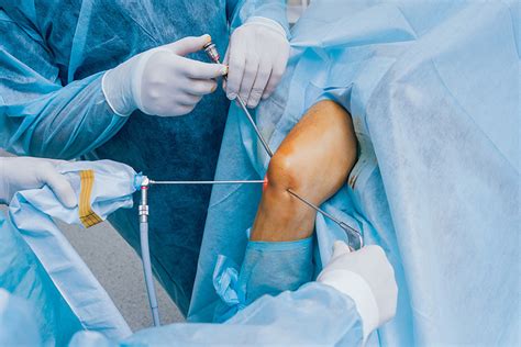 Schema introductiva a procesului de artroscopie la genunchi si reconstructie ligament incrucisat anterior