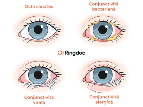 Copil cu ochi roșii și inflamați, sugerând conjunctivită