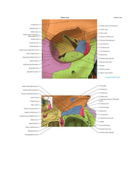 Schemă a orbitei oculare, indicând posibilele fracturi