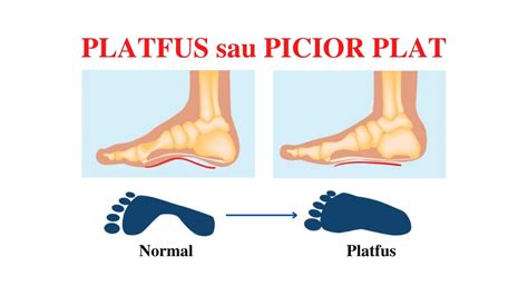 Ilustrație cu piciorul plat la copii și evoluția bolții plantare