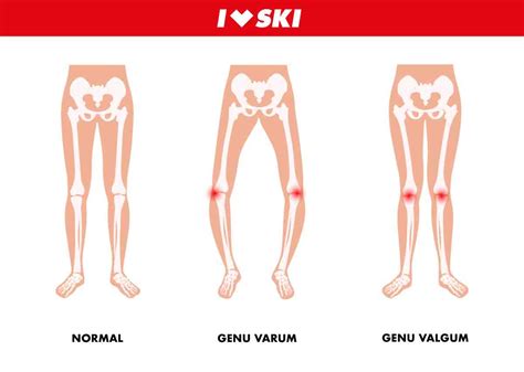 Copil care merge cu picioarele încrucișate (genu valgum)