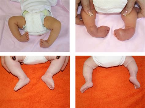 Copil cu picior varus equin (picior strâmb)