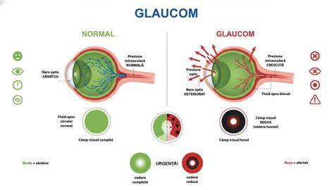 Infografic: Cronologia unei crize de glaucom și pașii de protecție