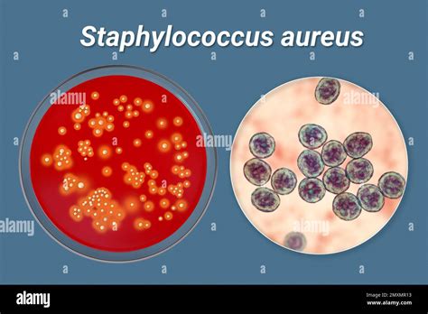 Infografic despre tipurile de infecții cauzate de Staphylococcus aureus