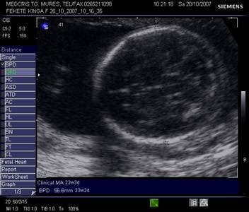 Biometria fetala: parametri principali, interpretare si utilizare