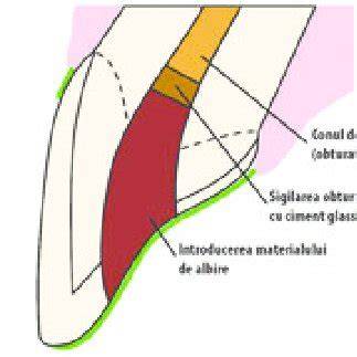 Schema aplicării corecte a scutecului