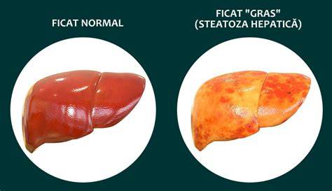 Diagramă: factori de risc pentru steatoza hepatică MASLD
