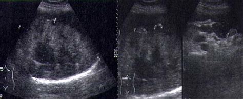 Exemple de raport ecografie hepatică: ficat mărit cu margine netedă vs. margine neregulată