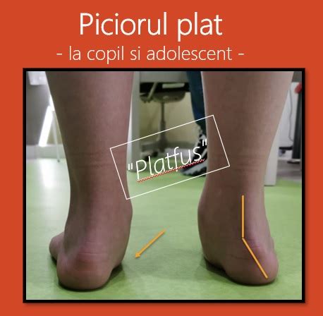 Copil examinându-și piciorul la medicul ortoped