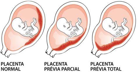 Infografic despre clasificarile placenta praevia si termenele-cheie