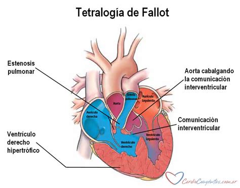 Anatomia inimii cu tetralogia Fallot