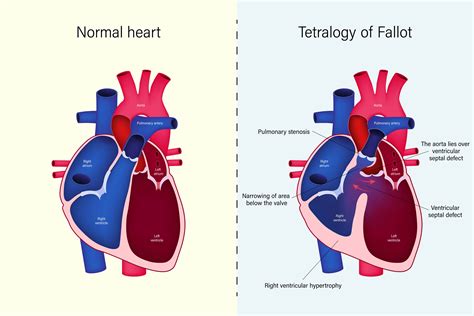 Inimă sănătoasă vs. Inimă afectată de Tetralogia Fallot