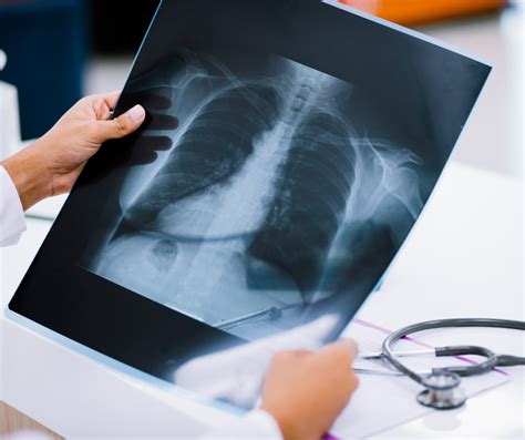 Analiză imagistică și monitorizare: radiografia toracică în sarcină, cu doze reduse