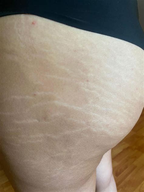 Infografic: etape tratamente vergeturi post-partum