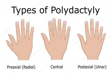 Infografic: tipuri de polidactilie (preaxial, postaxial, central) și opțiuni de tratament