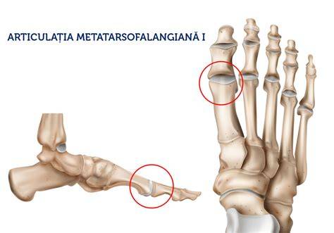 Diagramă a poziționării monturilor la nivelul articulației metafalo-falangiene (hallux valgus)