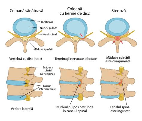 Secțiune transversală a coloanei vertebrale cu hernie de disc