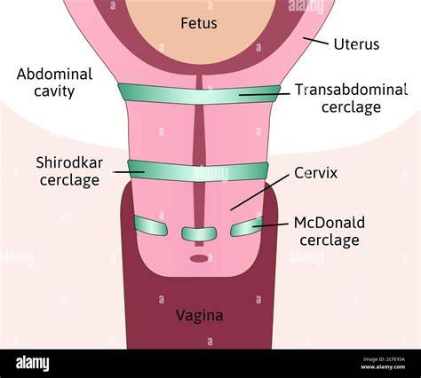 Infografic: Cerclaj cervical - transvaginal si transabdominal, indicatii si riscuri