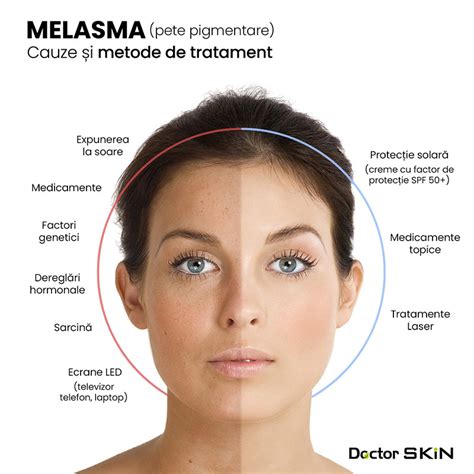 Infografic: tipuri de melasma (epidermal, dermal, mixt) și opțiuni de tratament