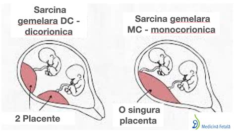 Diagrama Sarcina Gemelara