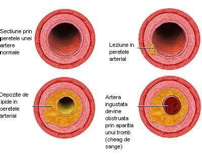 Infografic: Calea LDL spre placa de aterom