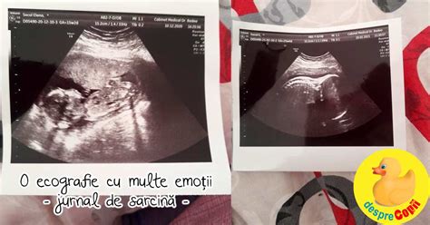ecografie translucenta nucala si dublu test