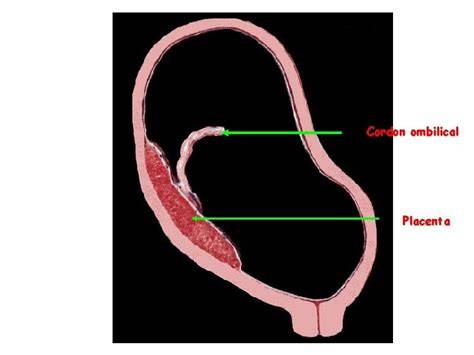 Macroscopic placenta cu placenta accreta si cordon ombilical cu hematom