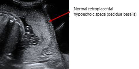 Ultrasound retroplacental space interrupted
