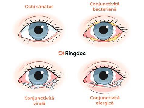 Infografie: Tipuri de conjunctivită la copii și tratamentele recomandate