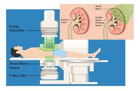 Schema procedură ESWL și montare stent ureteral