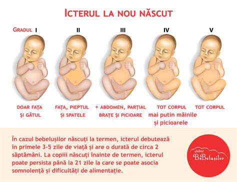 Diagrama Kramer pentru aprecierea intensității icterului la nou-născuți
