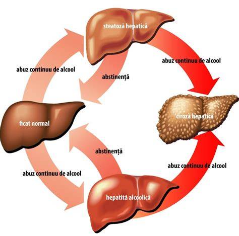 Infografic: etapele cirozei hepatice și efectele alcoolului asupra ficatului