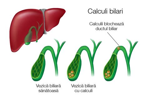 Infografic: Cum se formează calculii biliari și cum apare colica biliară
