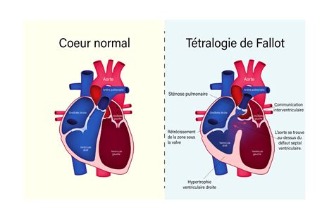 Diagramă comparativă a unui ECG normal și a unuia cu semne de Tetralogie Fallot