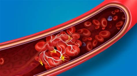 Vizualizarea microscopică a unui cheag de sânge în interiorul unui vas sanguin.