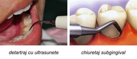 Infografie: etape chiuretaj subgingival si obiective terapeutice